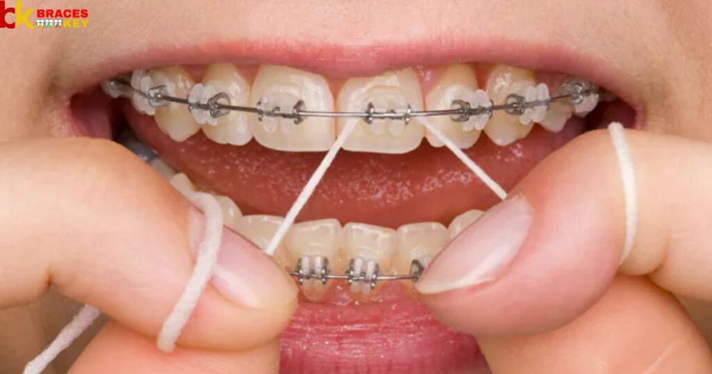Use A Floss Threader Or Special Orthodontic