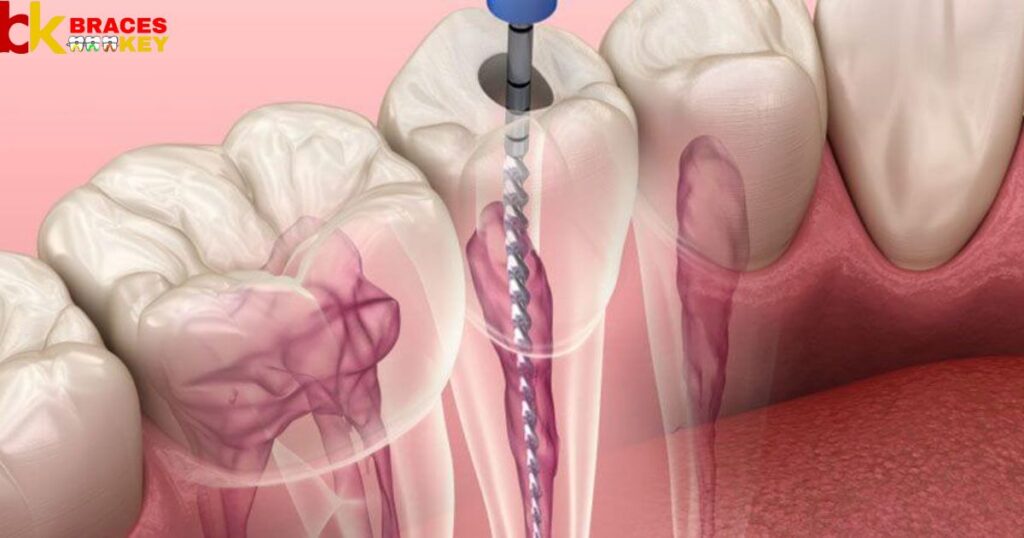 What Happens After A Root Canal