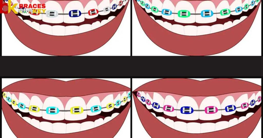 What Is The Best Color For Your Braces