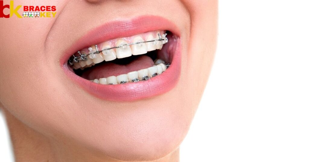 Why People Choose Red Braces