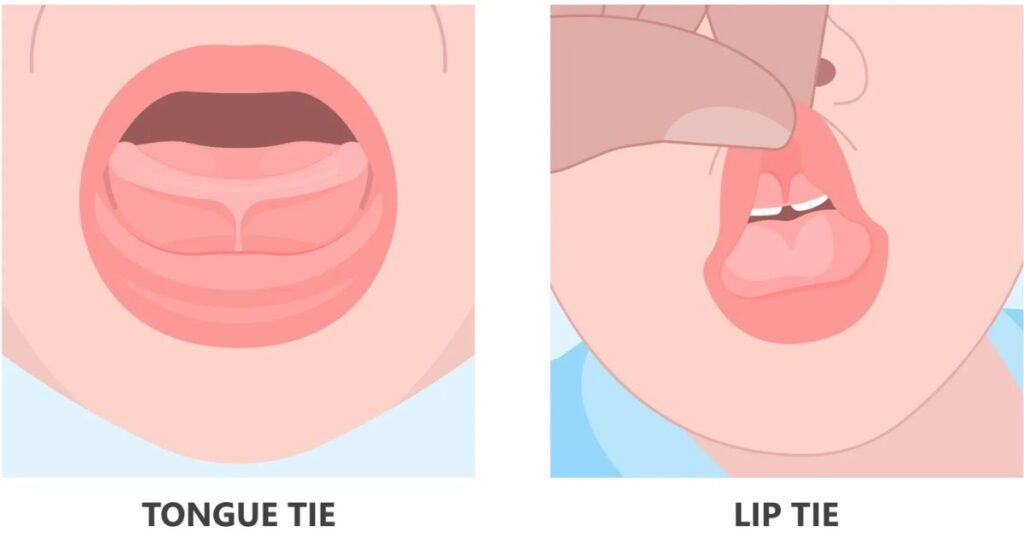 What are Lip and Tongue Ties