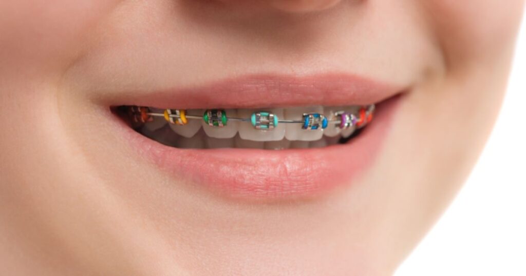 Braces Colors - A Rainbow of Possibilities