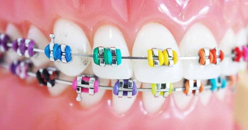 Considering Different Braces Color Options