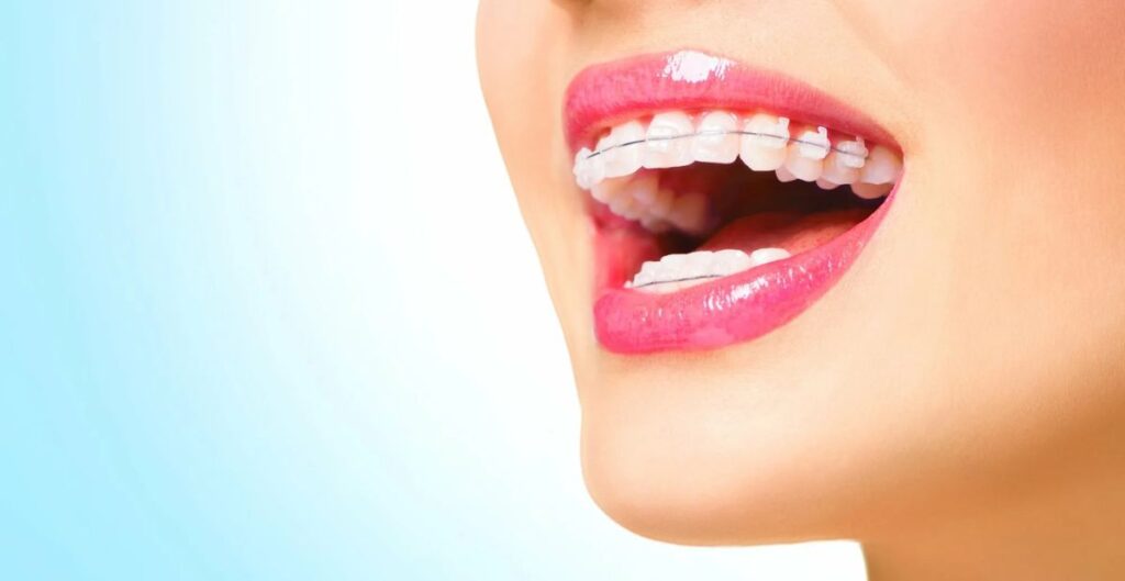 Other Common Concerns About Lips During Braces Treatment