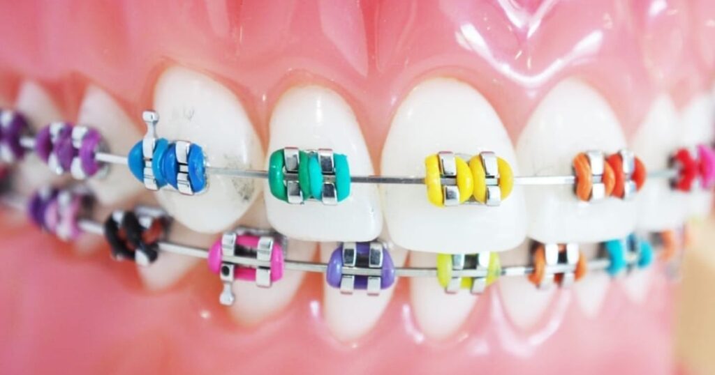 There are Many Colors of Braces to Choose From