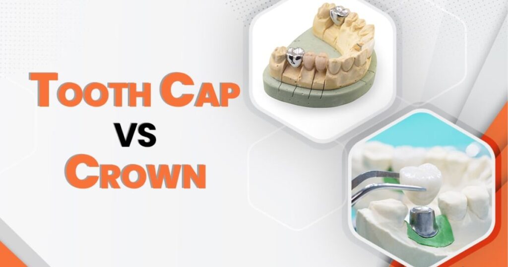 Tooth Cap Vs Crown