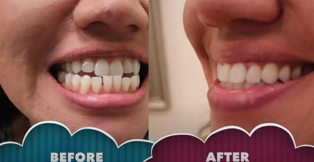 Types Of Underbite Correction Treatment And How To Choose