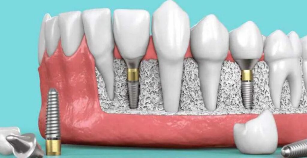 Understanding the Breakdown of Dental Implant Costs in Glasgow
