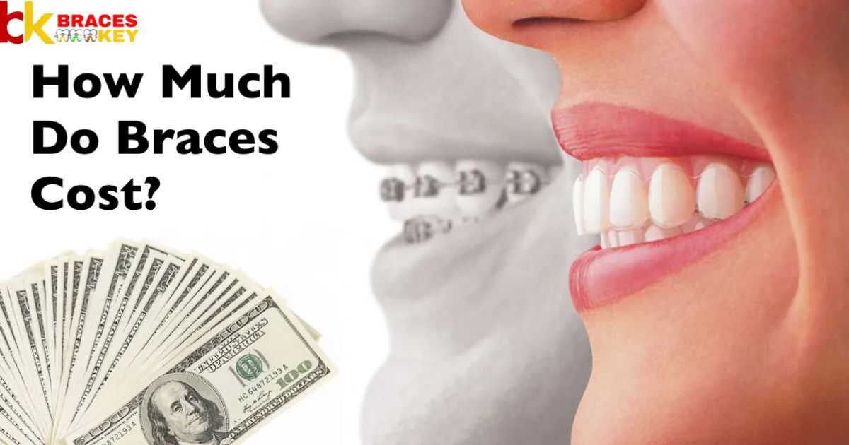 Much does it cost to remove braces