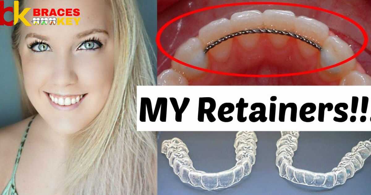 Do You Have To Wear Retainers Forever After Braces