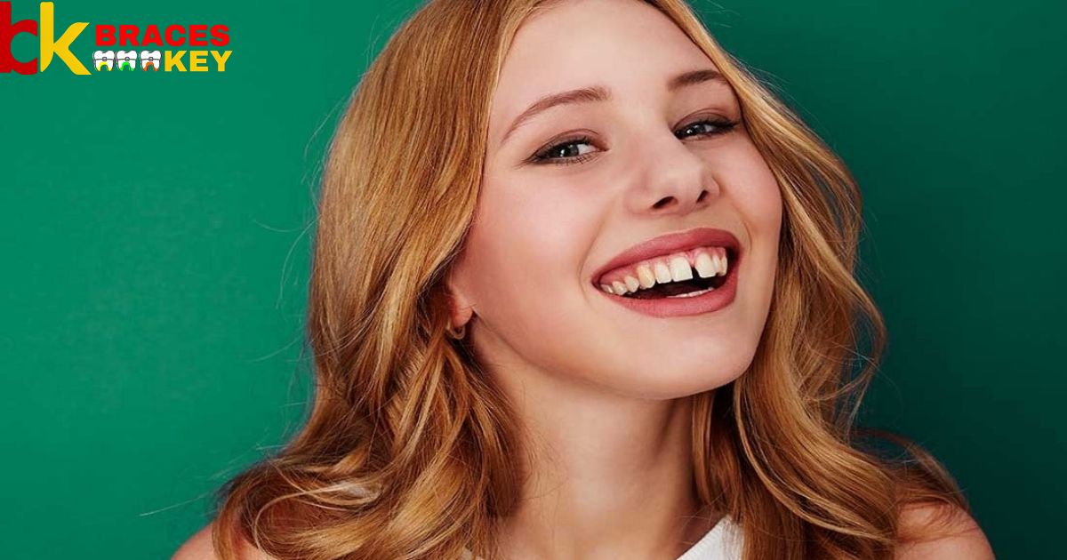 How To Close A Gap In Your Teeth Without Braces