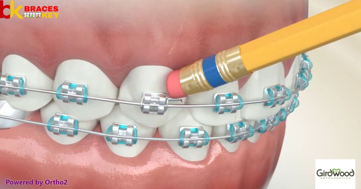 Stop braces wire from poking without wax