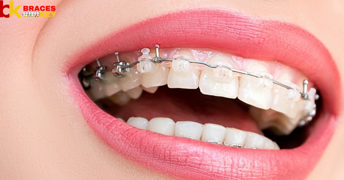 What braces colors make your teeth look whiter