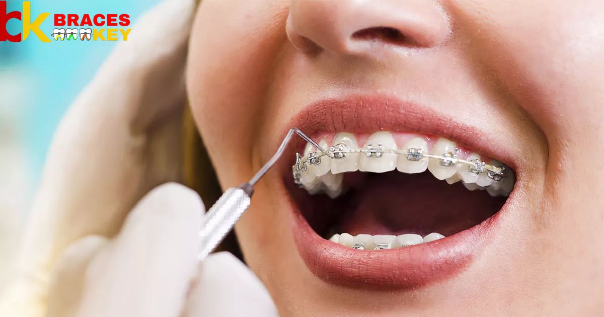 What Happens If You Get A Cavity With Braces?