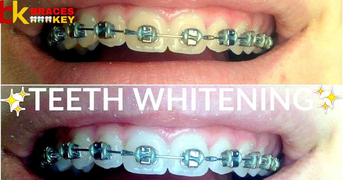 What Color Of Braces Makes Your Teeth Look Whiter