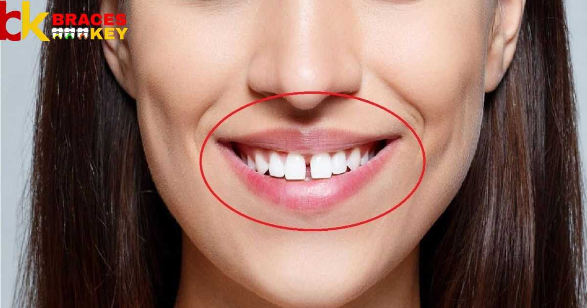 To Fix Gap In Front Teeth Without Braces
