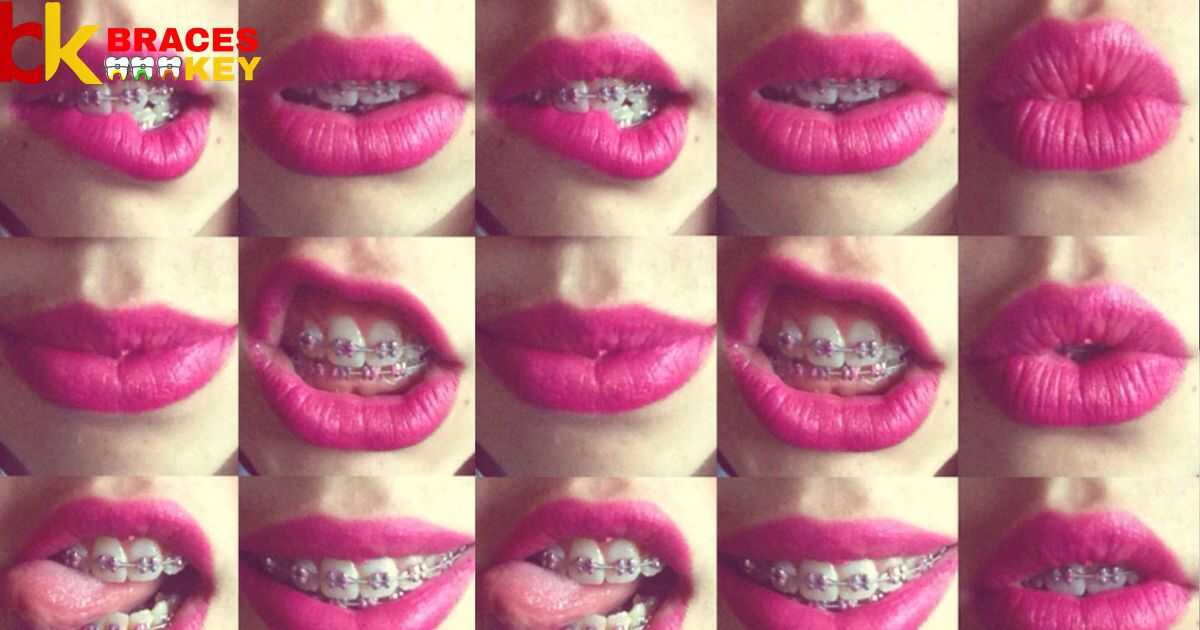 Is Hot Pink A Good Color For Braces