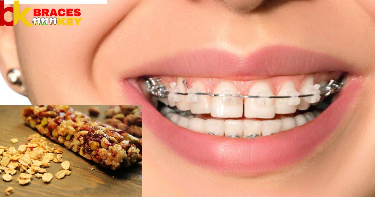 Can You Eat Chewy Granola Bars With Braces