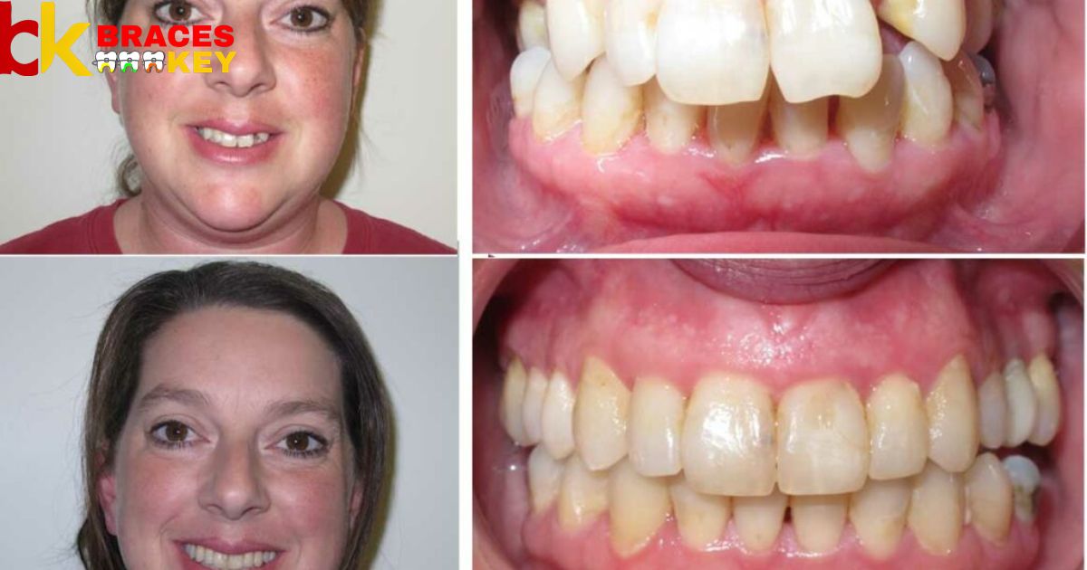 Can You Fix An Overbite Without Braces