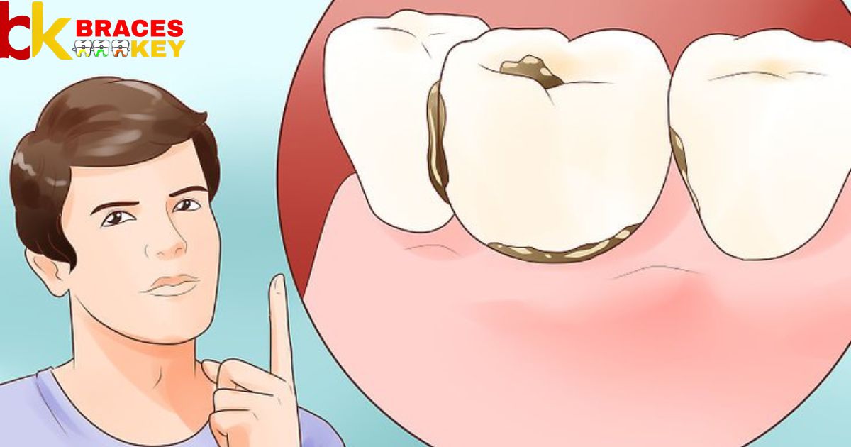 How To Tell If You Need Braces Quiz