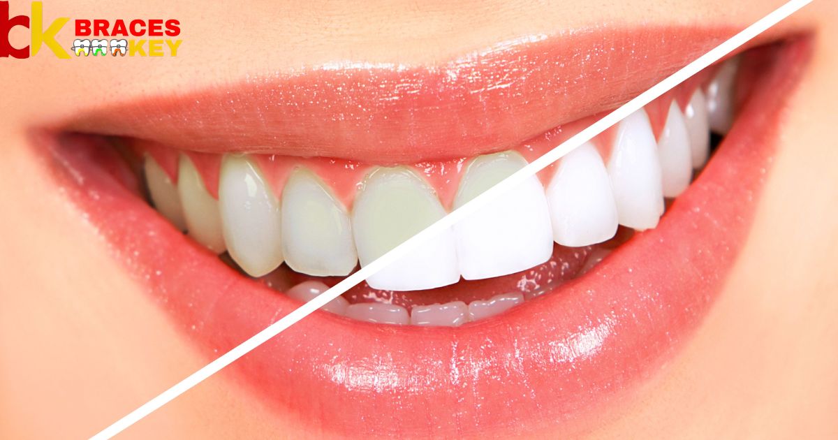 To Get Rid Of White Spots After Braces