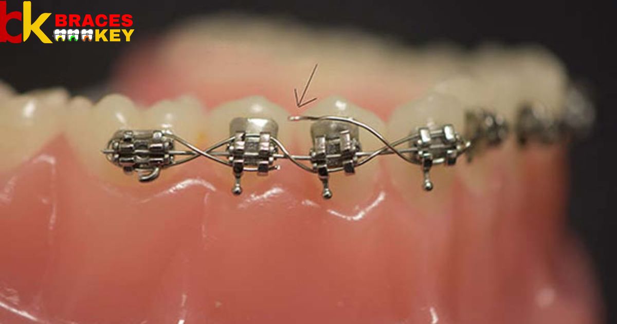 What To Do If The Wire In Your Braces Bends