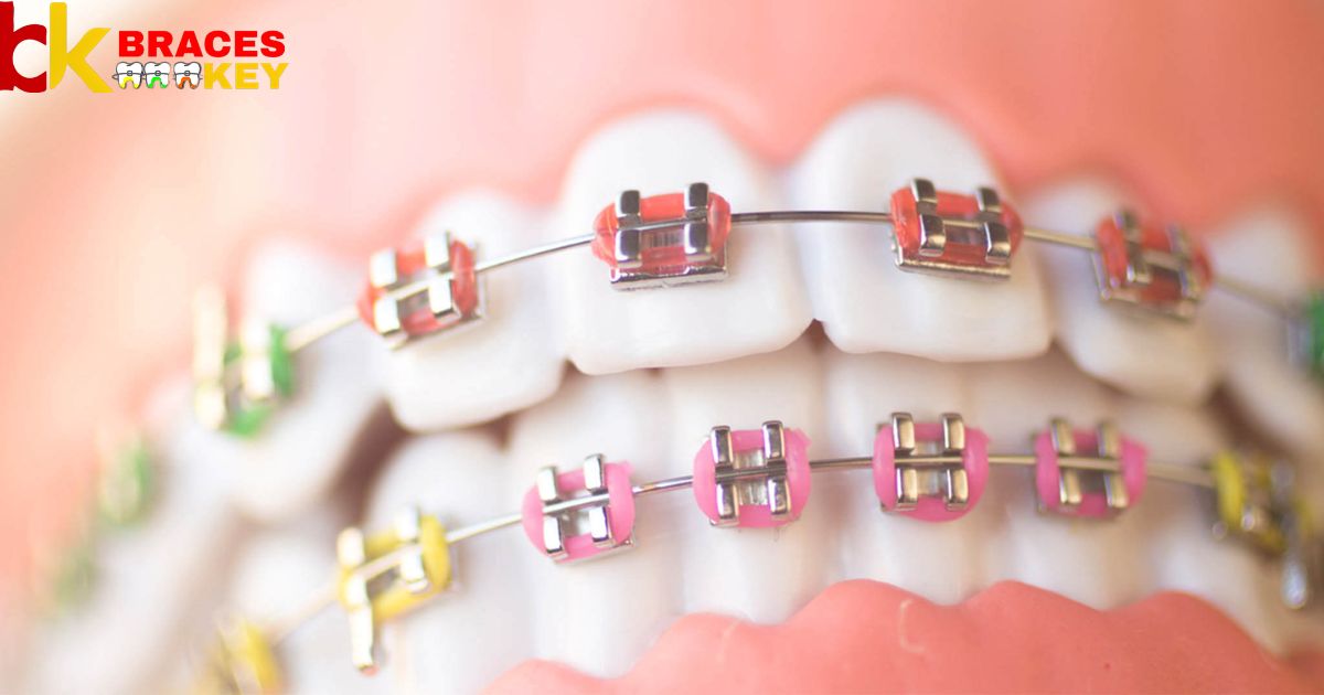 What To Do When Wire Pops Out Of Braces