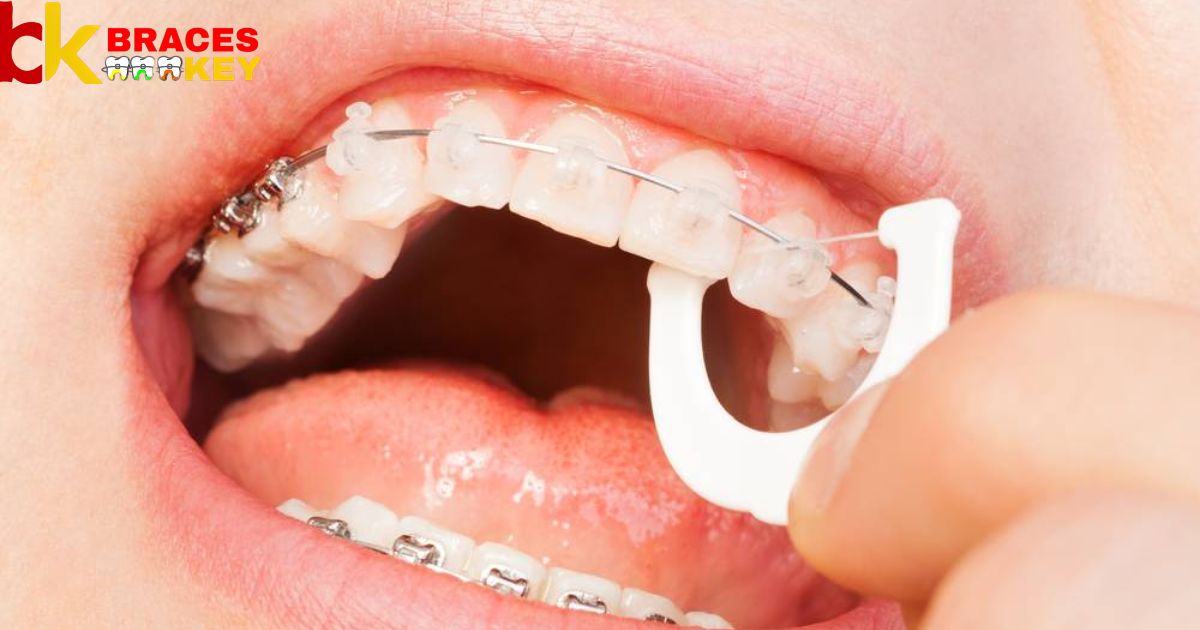 What Type Of Floss Is Best For Braces