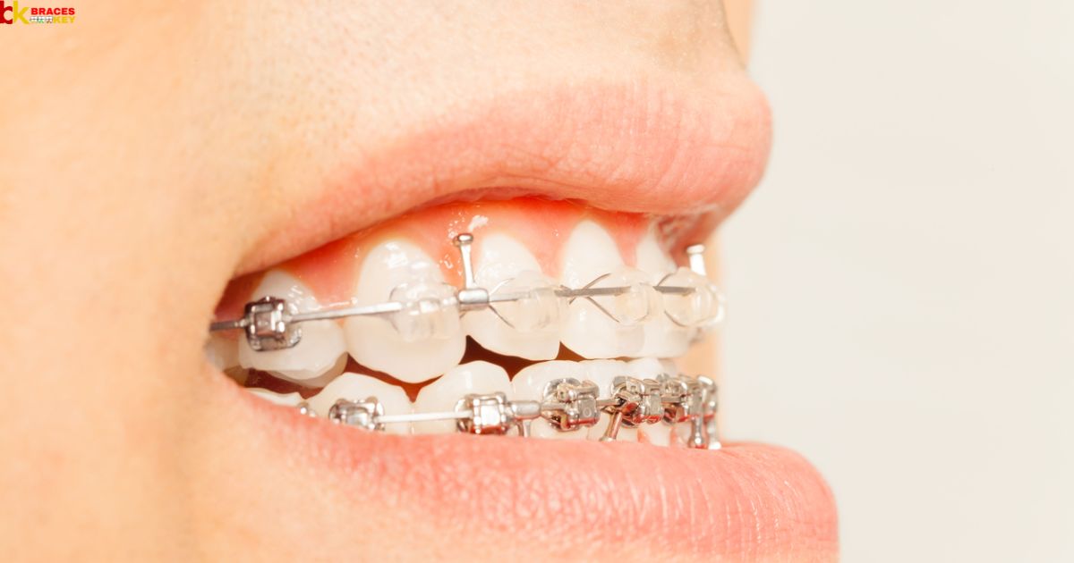 Can Braces Expand Lower Jaw?