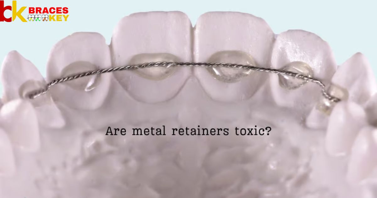 Are Metal Retainers Toxic A Guide For Concerned Patients