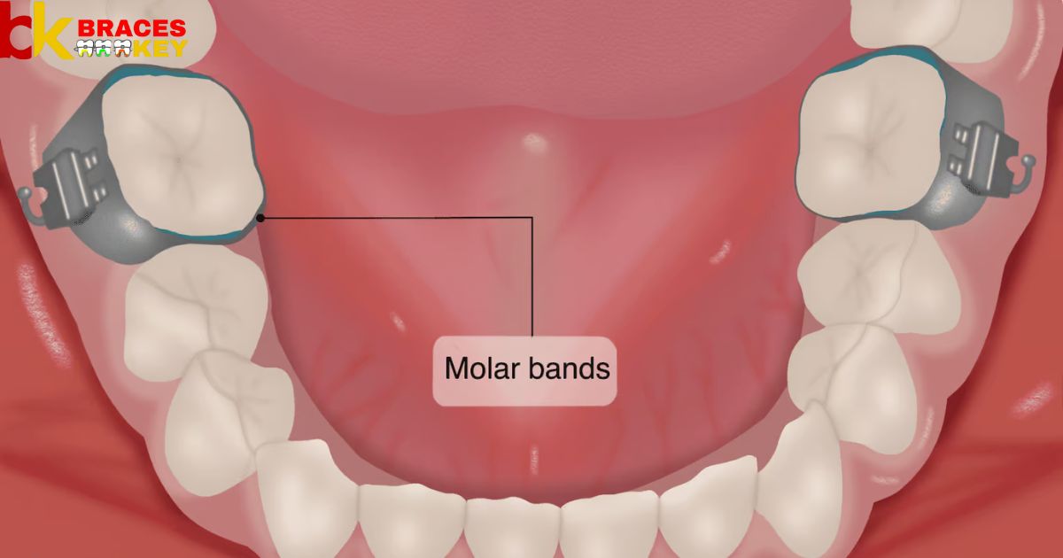 Are Molar Bands Necessary