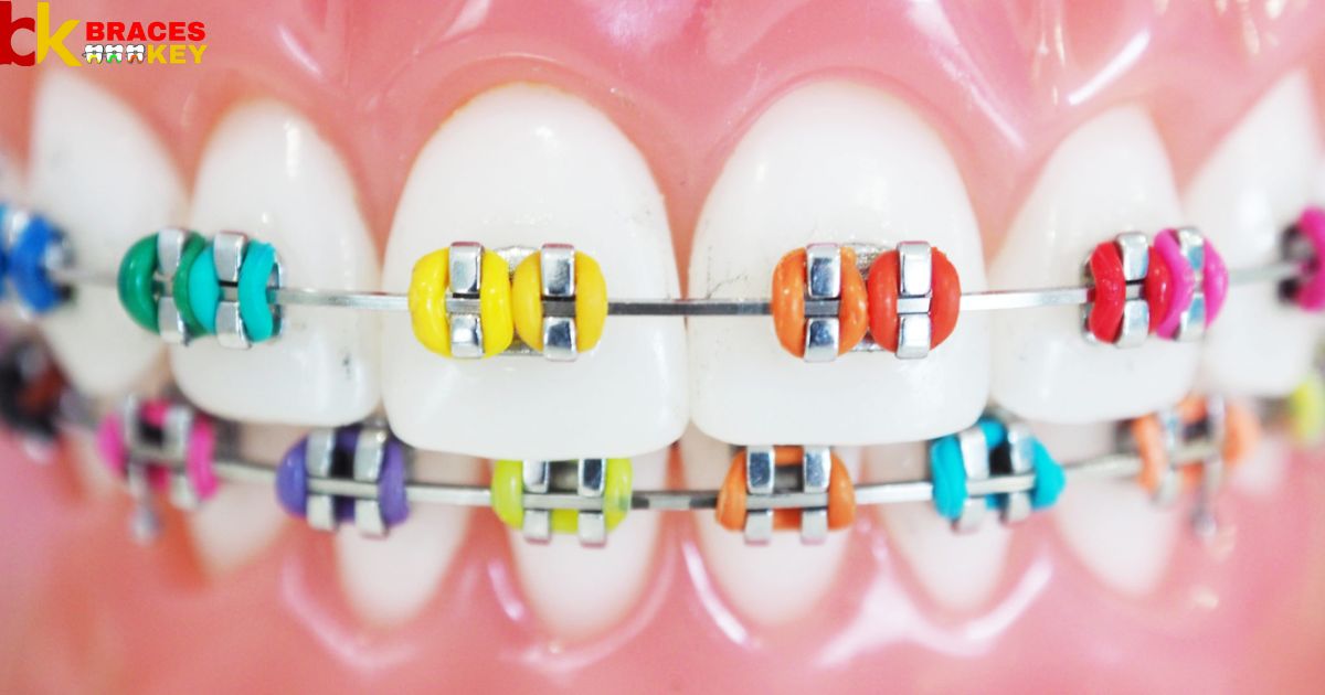 Braces Band Colors Can Make Your Teeth Look Whiter