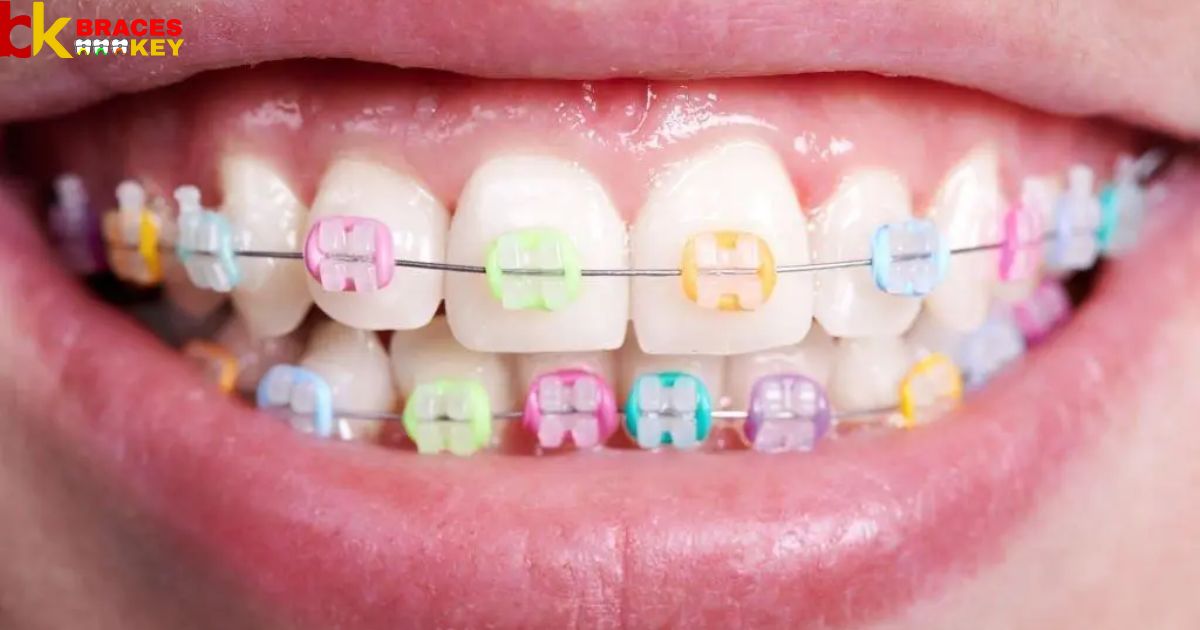 Find The Most Flattering Braces Colors For You