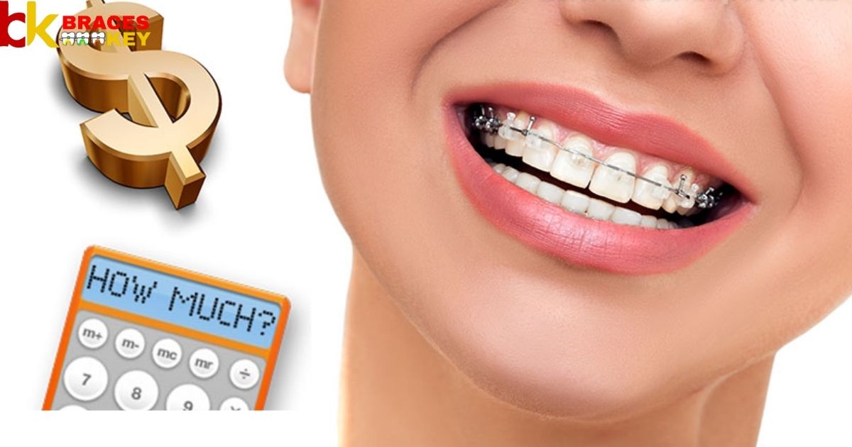 How Much Braces Cost In India