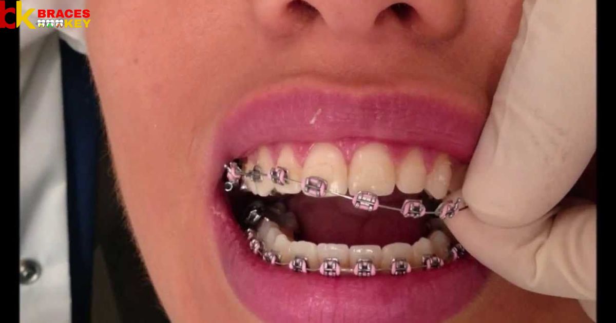 Is It Necessary To Remove Teeth For Braces