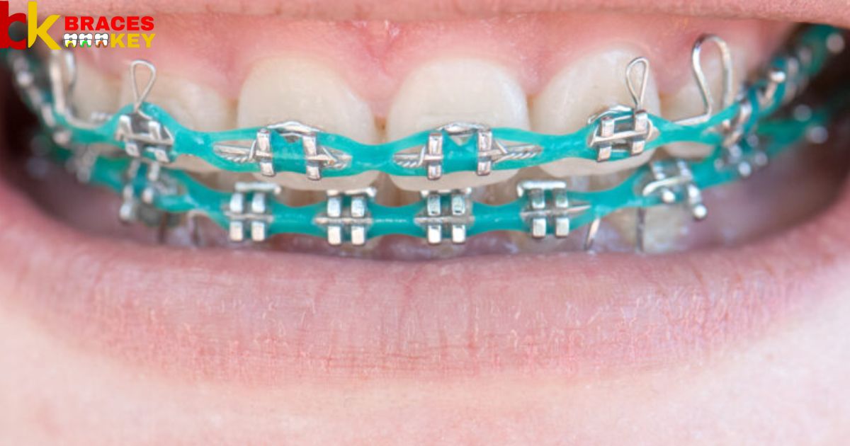 Is Teal A Good Color For Braces