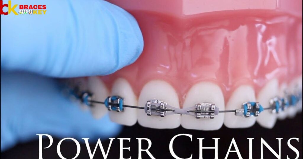 Power Chain Braces Everything You Need To Know