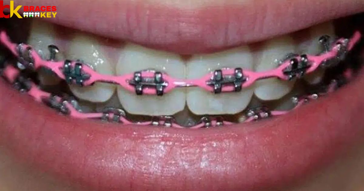 Power Chains On Braces