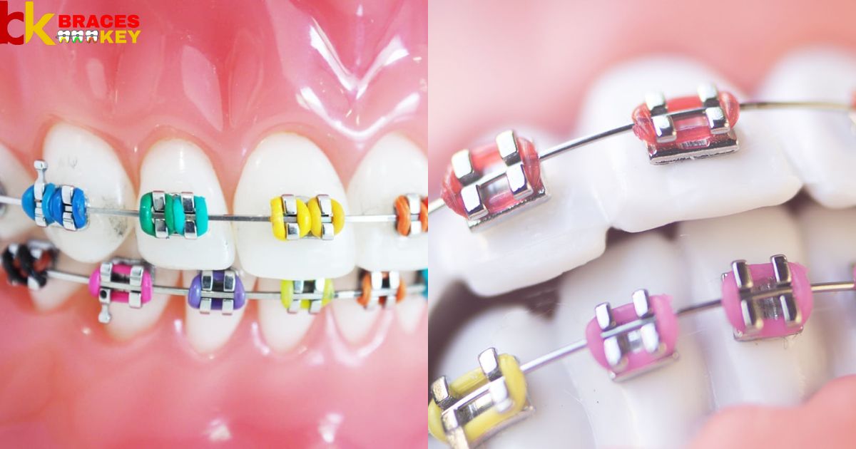 What Are The Best Braces Colors