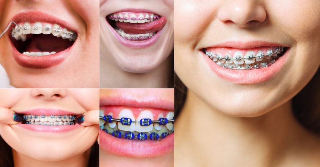 5 Tips for Getting Your Braces Off on Time