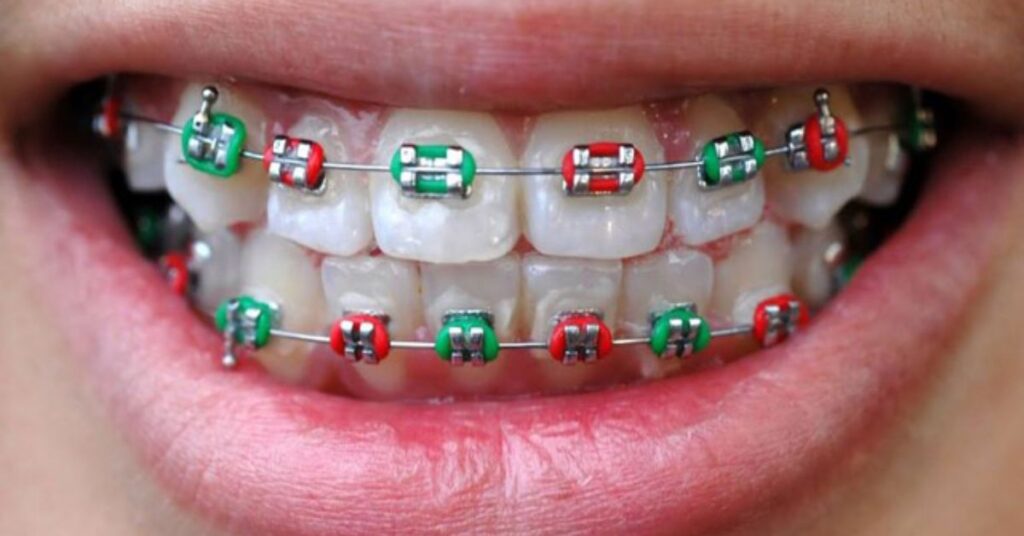 How Long Do You Have to Wear Braces?