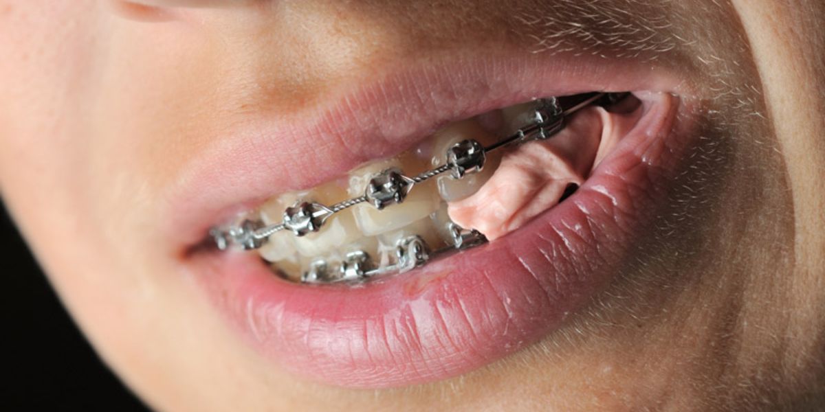 Can You Eat Gum With Braces?
