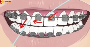 How To Floss With Braces