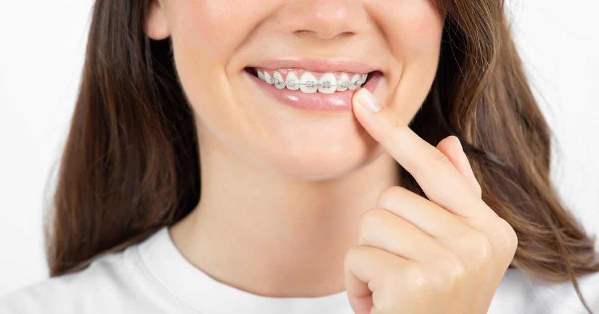 Free Braces with Medicaid: Your Guide to a Brighter Smile (Everest Dental)