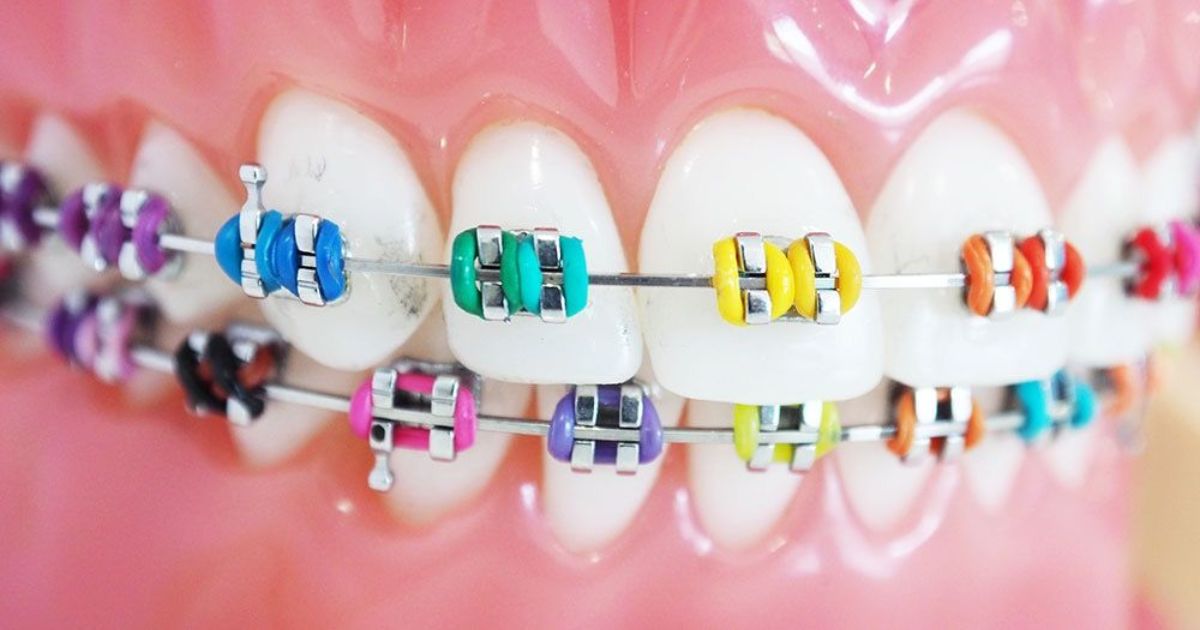 Braces Colors - Expressing Your Style While Straightening Your Smile