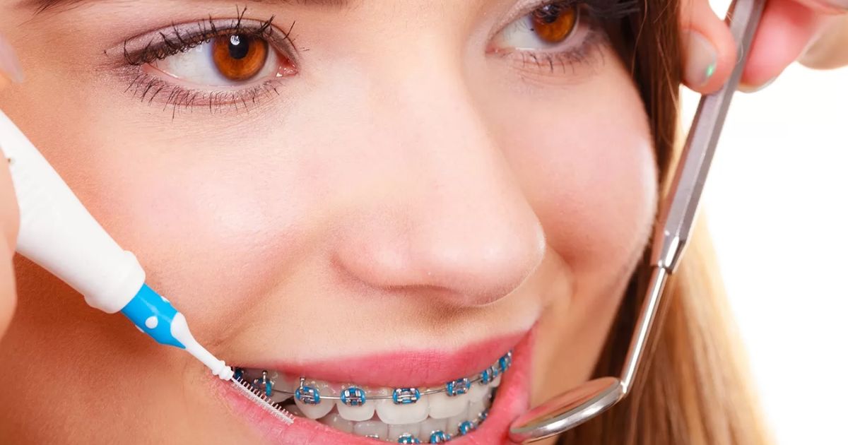 Braces Colors That Make Your Teeth Look Whiter