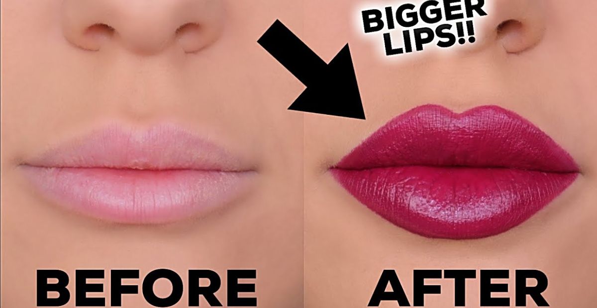 Do Braces Make Your Lips Bigger?