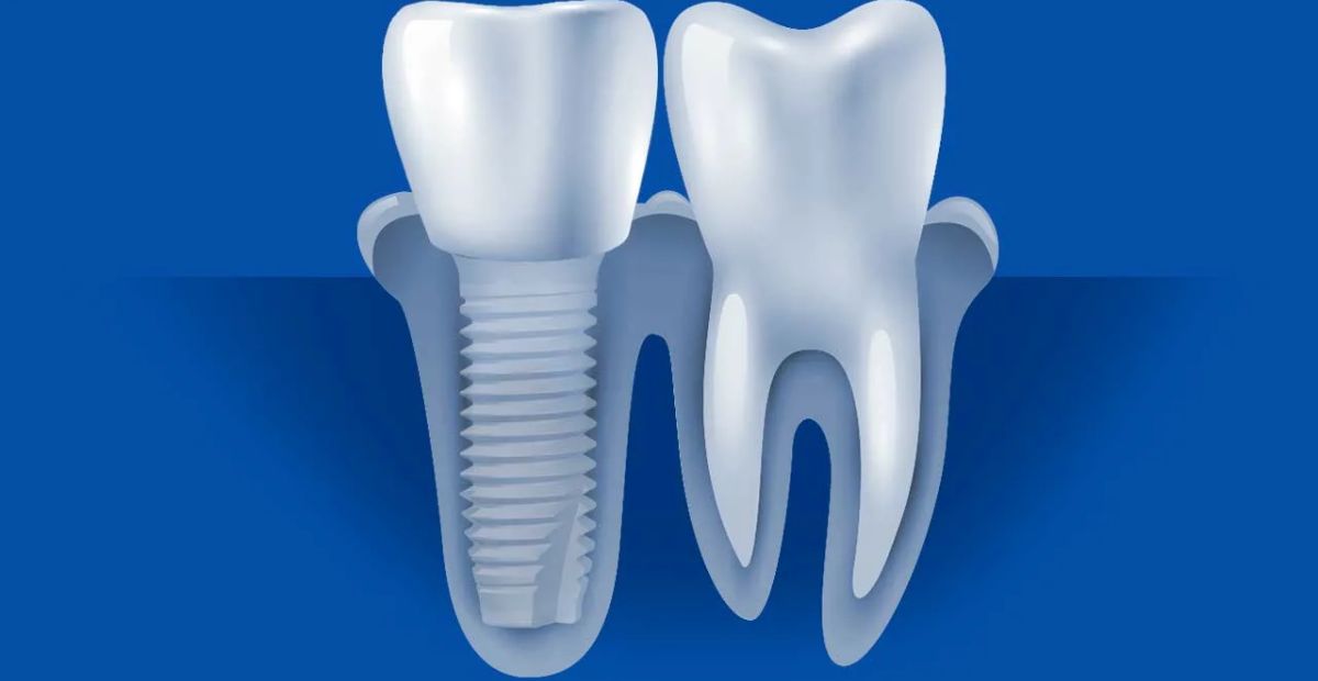 The Cost of Dental Implants in Glasgow