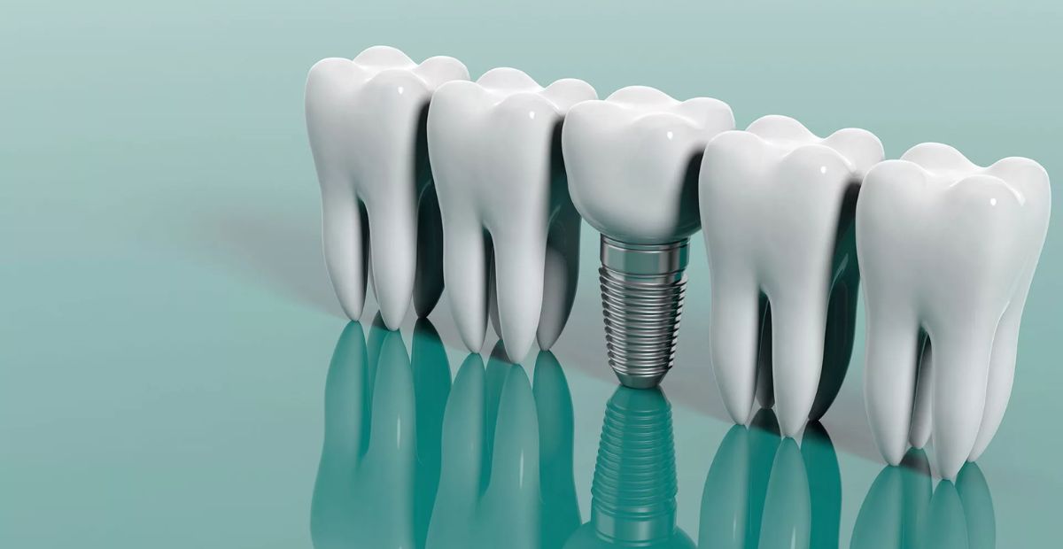 Tooth Implant Prices